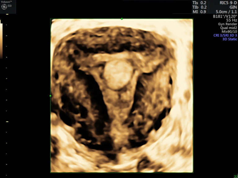 3D transvaginal ultrasound showing an endometrial polyp.